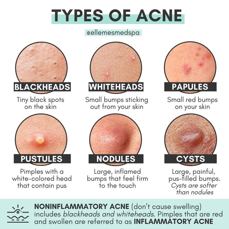 Types of Acne Reference Image